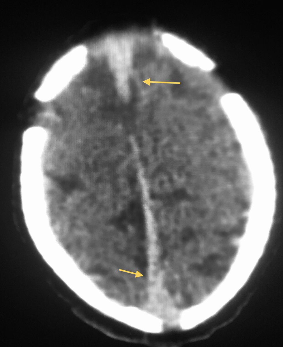No contrast, no hemorrhage, no venous thromboses: 🟡Normal 👶🏼 head CT ⬆️ sinus/veins density👇 ⬆️Hemoglobin concentration and the rest of hematological parameters during the 1st week of life. In case of doubt or confusion in the clinical setting: ✅Doppler is a great solution