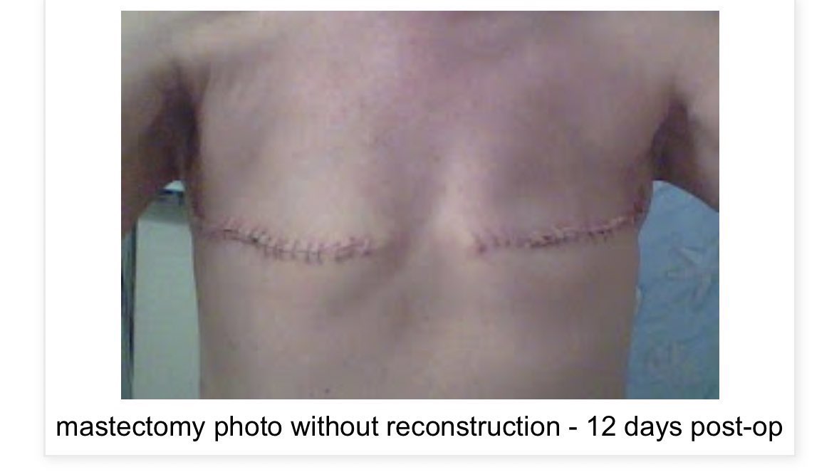 İnternetten bulduğu fotoğrafları kesip lgbt getirisi algısı yapan sözüm ona profesör, böyle insanlar çok tehlikeli dikkat edilmeli. Fotoğrafın aslı; meme kanseri sonrası mastektomi. Genelde böyle isteklerde bulunmam ama bu zararlı kişileri şikayet edip engellemenizi tavsiye