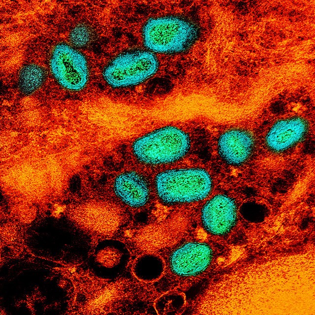 CIDRAP's tweet photo. Study on #mpox in homeless notes that 60% also had #HIV

No transmission was noted in encampments, despite potential sharing of sleeping bags, clothes, and utensils

https://t.co/ZJBtDFqzev https://t.co/U2U622Dcq7