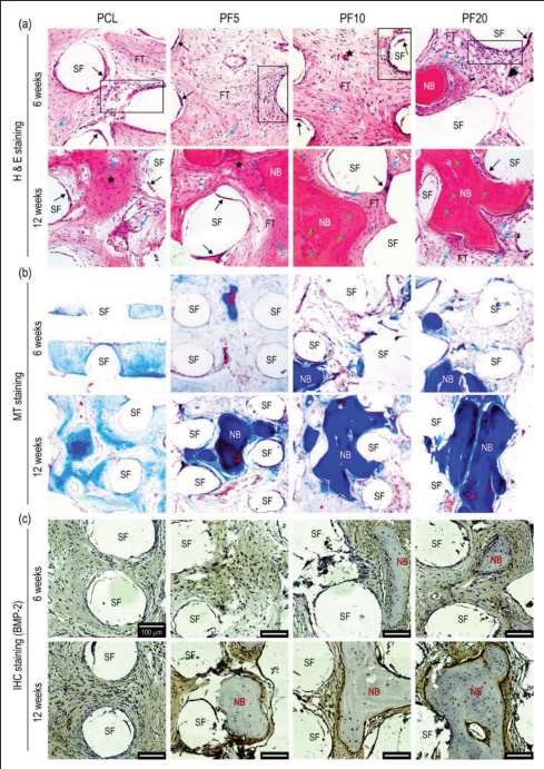 IJB_ASP's tweet photo. Welcome to read this article from International journal of bioprinting. 🤗
#FeS2-incorporated 3D #PCL #scaffold improves new bone formation and #neovascularization in a rat #calvarial defect model
More details:👇👇
https://t.co/wM3ctnVJAQ https://t.co/E1kRpcwpjI