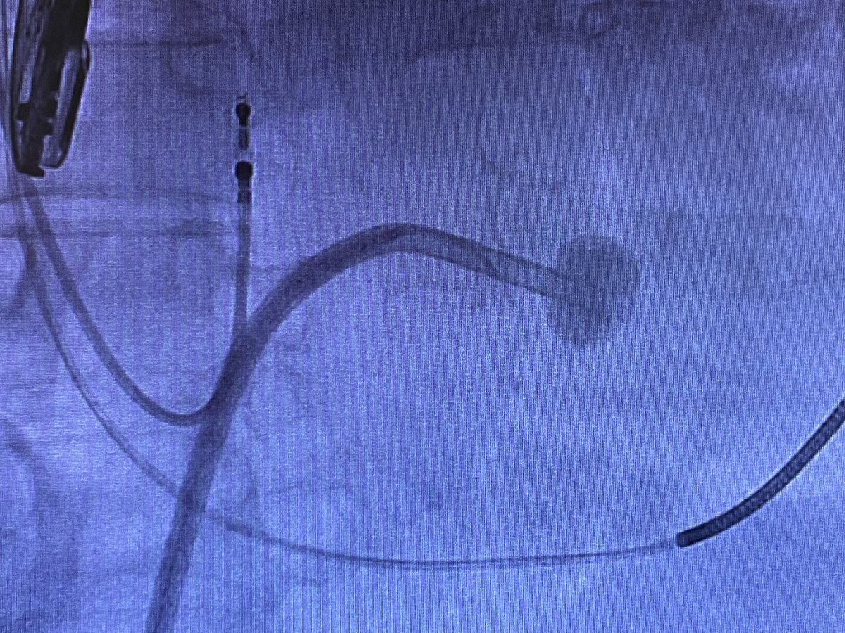 Great #SafeCross cases today! Smart device that allows highly precise, stress-free transeptal crossing. @brijmaini @eastendmedical