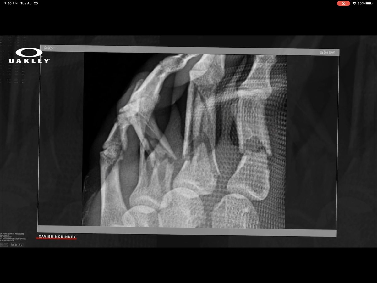 clt_ny's tweet photo. McKinney’s finger.  YIKES!

He said at the time he’ll be back “in a few weeks.” https://t.co/nBDrq6VH3F