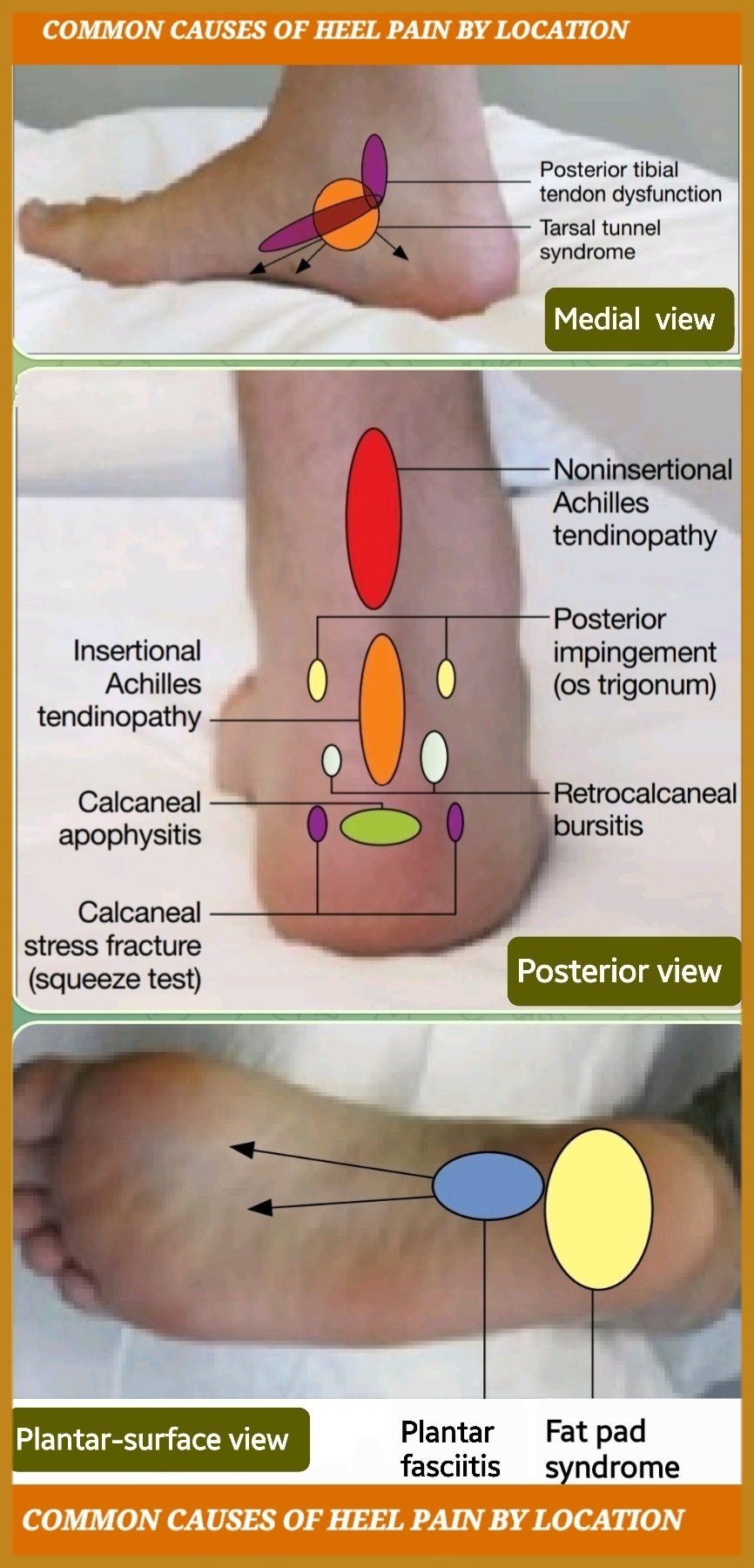 7 Heel Spur Myths and Facts | Heel That Pain