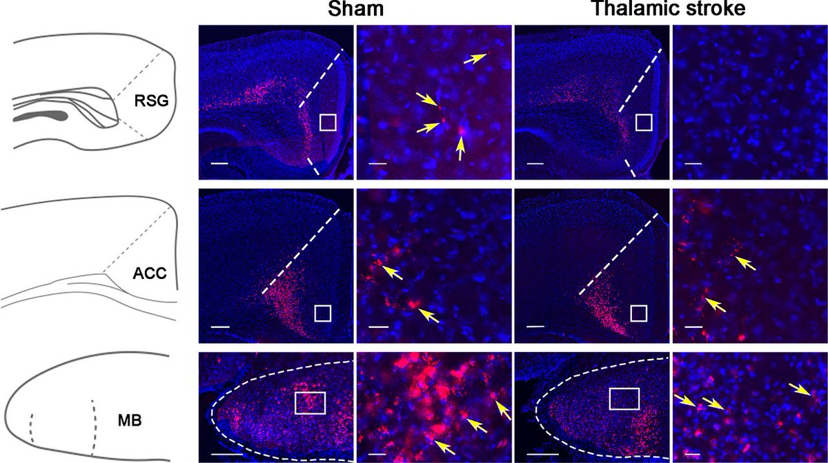 SVN_CSA's tweet photo. Photochemically induced thalamus infarction impairs cognition in a mouse model #thalamusinfarction #Photochemically #cognition
https://t.co/kJ4TSJzzoX https://t.co/GR9vQNPy5X