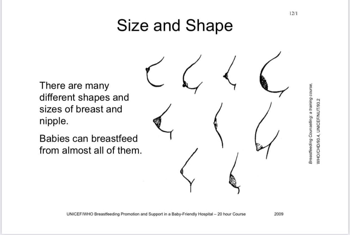 DrMuhammadizzat's tweet photo. Unpopular opinion

“Larger breasts make more milk”

Although your breasts will likely grow larger before and during your breastfeeding journey, breast size is irrelevant when it comes to how much milk you produce. A mom with small breasts might have just as much milk supply as a mom with large breasts.

Just to share, i pernah encounter this one unforgettable case in my postnatal ward. 

Mak ni baru bersalin, then breastfeed her baby atas katil sambil mengiring. Beliau tertidur and her big boops ‘hempap’ baby’s face. 

The baby asphyxiated, cyanosed and breathless. 

So, having big boops may cause harm and unwanted issues in breastfeeding. Please be careful 🙏