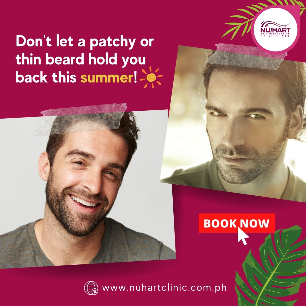 Summer's here, and it's the perfect time to rock a new beard look! Our beard hair transplant can help you achieve that effortlessly. 📷📷
Take the first step towards a new and improved look today!
Message us to book an appointment!
#bearhairtransplant #beardtransplant