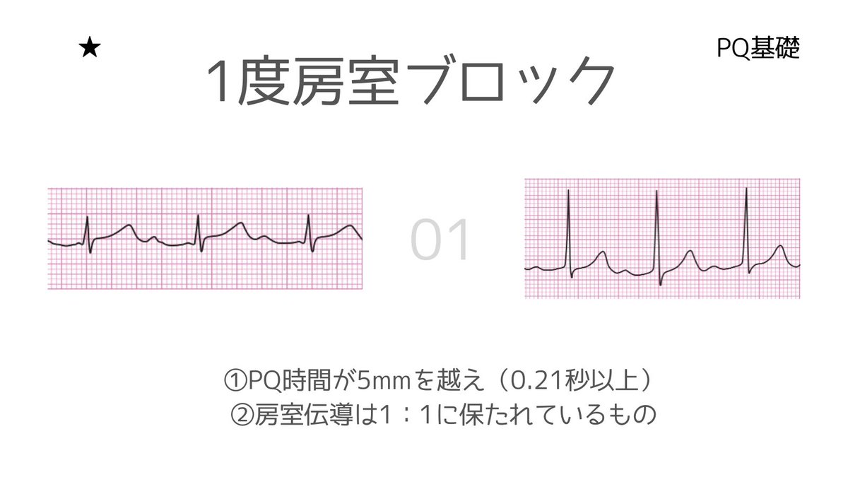 一度房室ブロック 波形 : 【初心者向け】これでなっとく！一度ブロック（1AVB）の見分け方 – NVXO