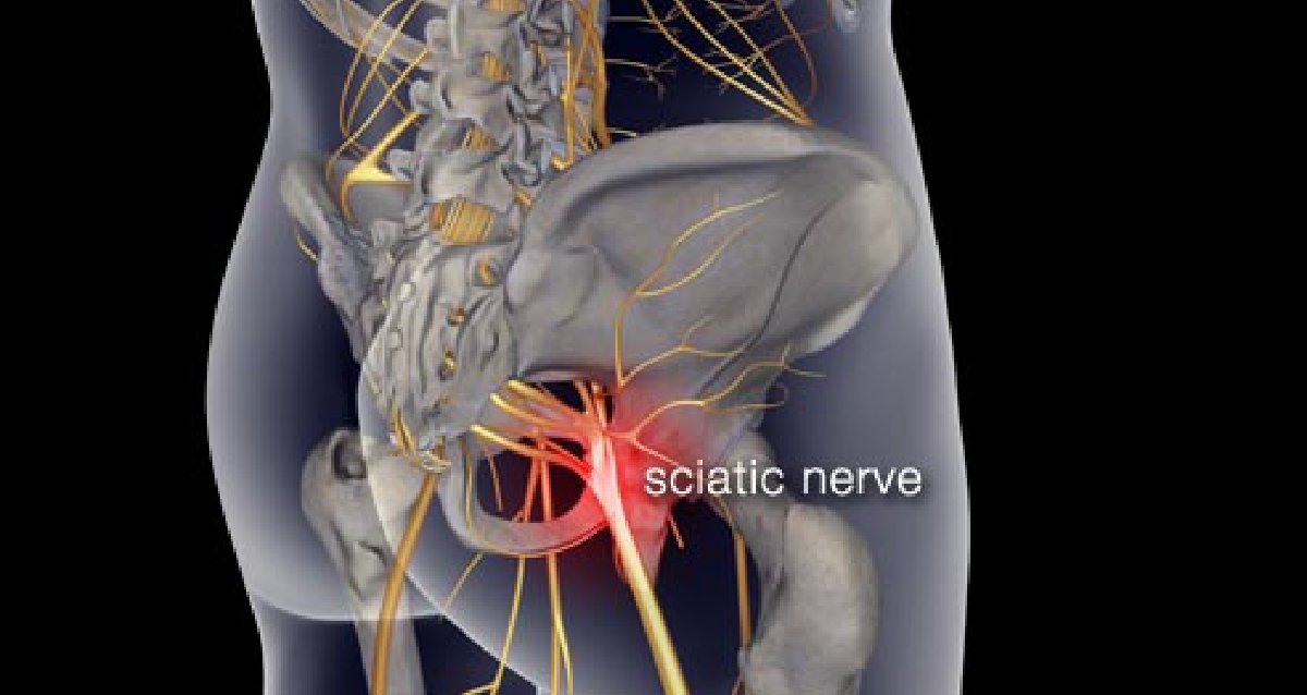 WebMD's tweet photo. “Wait and see” might not be what you want to hear when you have sciatic pain, but it works. About 80%-90% of people with sciatic nerve pain get better within a few weeks. https://t.co/3wnvXlEdEs https://t.co/0TeEjFly5l