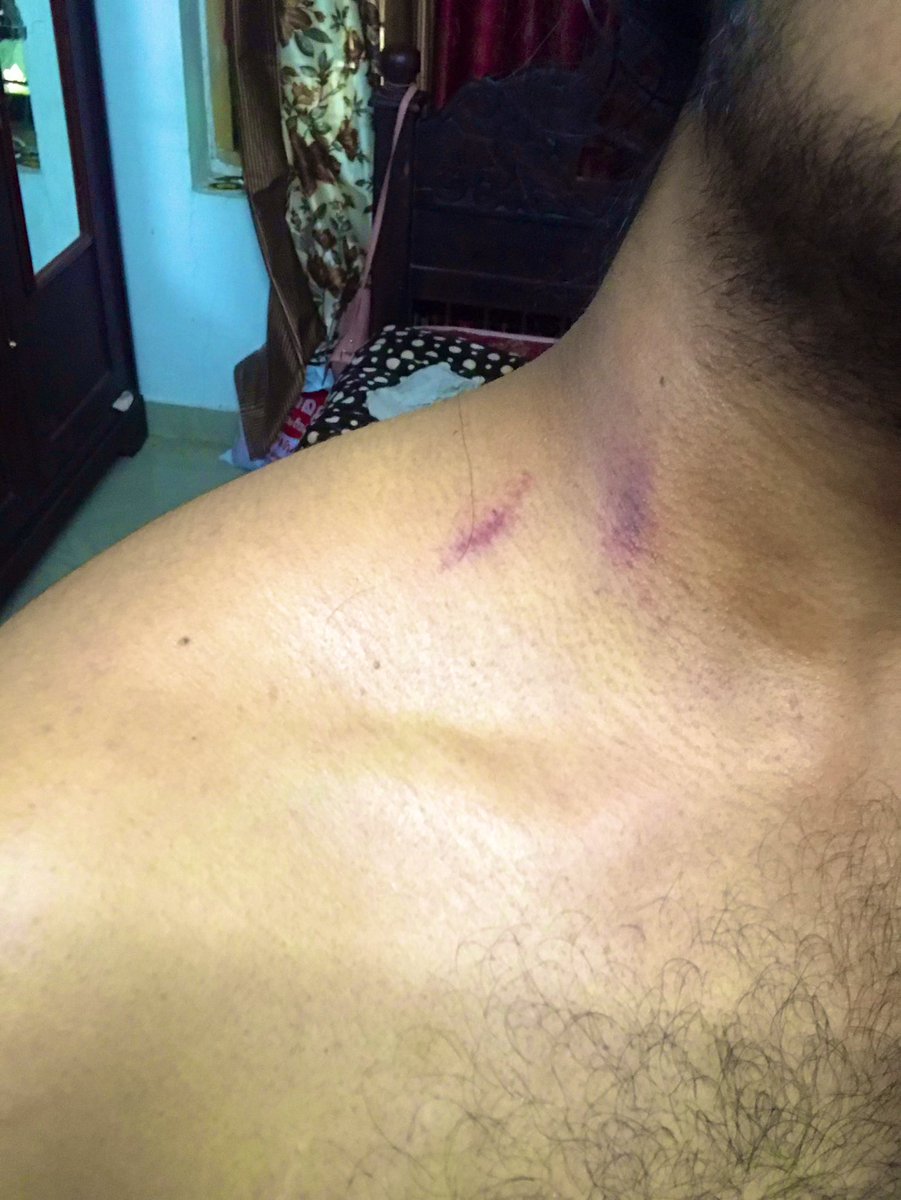 libido_Tcr's tweet photo. Fk i hate this!😑🫠 #hickey https://t.co/vgSYhGEp6B