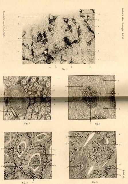 DrTravisBrown's tweet photo. Future #ThisMedLife #podcast

Autoimmune thyroid disease

Hashimoto disease

Described by Hakaru Hashimoto in a German journal 1912

4 middle aged women who had a thyroidectomy with lymphoid infiltration

‘Struma lymphomatosa’
➡️became Hashimoto disease

Image 1 original article https://t.co/nZxANiygjk