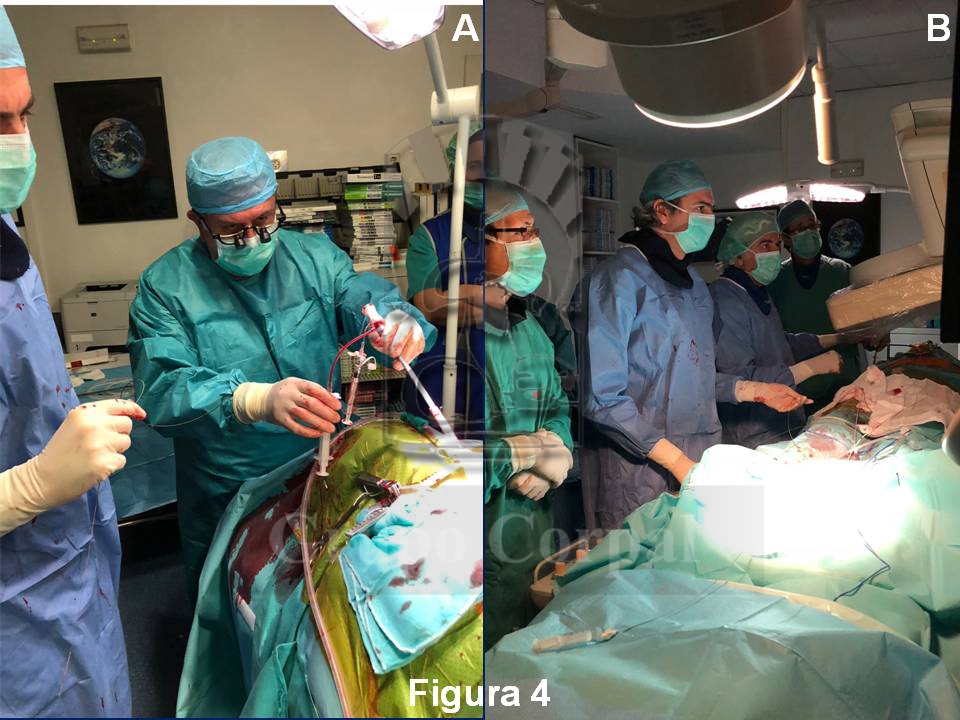 Implantación directa trans-aórtica de prótesis CoreValve en paciente con estenosis aórtica crítica y múltiples comorbilidades. 🫀 Procedimiento híbrido efectuado en @HcrCordoba.
#CardioTwitter #Cardiology 
Caso completo ⬇️
bit.ly/3LvSwTq