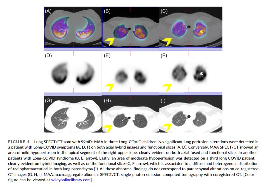 'There is increasing evidence that chronic endotheliopathy can play a role in patients with Post-Covid Condition (PCC, or Long Covid) by affecting peripheral vascularization'

➡️'Study provides further evidence that a subgroup of CHILDREN with PCC(#LongCovid ) has abnormal lung…