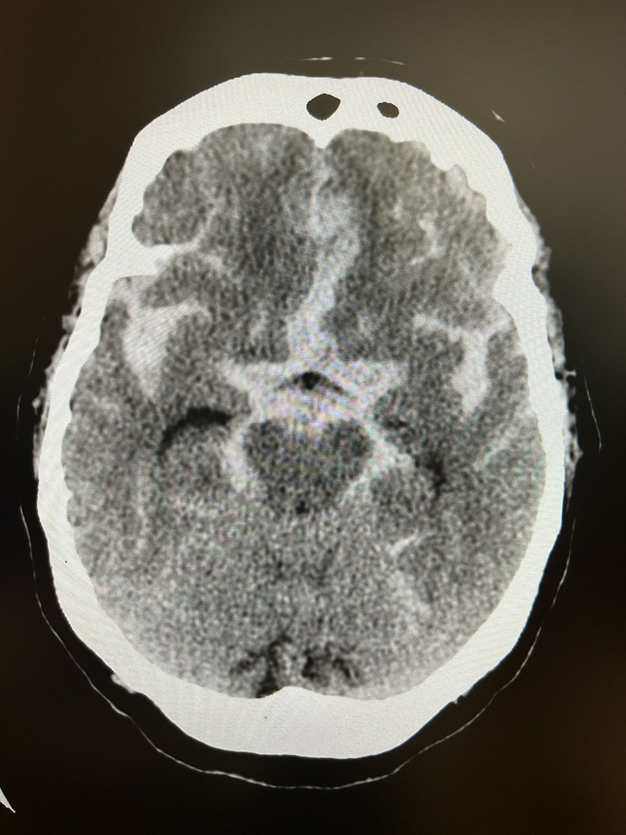 RobertoCorrea__'s tweet photo. Old school simple coiling technique.

A 66-year-old woman with subarachnoid hemorrhage, Fisher IV, secondary to a ruptured aneurysm of the anterior communicating artery.

Aneurysm coiling, 6x5mm aneurysm with 4mm neck, starting with a 5mm coil.
@NicoRomeroMD 
@VirTauli 
@Geni_NRI https://t.co/hiBvsl9tf1