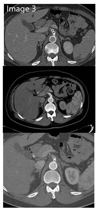 cirsesociety's tweet photo. CT after the procedure demonstrates stoppage of bleeding and non-replenishment of the hematoma. (Image 3)  #trauma #bleeding #withoutscalpel (5/5) https://t.co/DvKYBDfvl6
