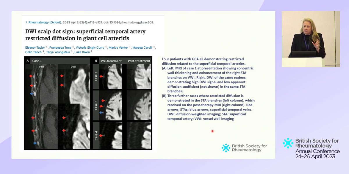 Robert Maughan (@r_maughan) on Twitter photo Fantastic talk on arterial involvement in large vessel vasculitis by our centre co-director <a href="/TYoungstein/">Taryn Youngstein</a> <a href="/RheumatologyUK/">BSR</a> at #BSR23 <a href="/ICL_Vasculitis/">Imperial Vasculitis Centre</a> Fantastic talk on arterial involvement in large vessel vasculitis by our centre co-director <a href="/TYoungstein/">Taryn Youngstein</a> <a href="/RheumatologyUK/">BSR</a> at #BSR23 <a href="/ICL_Vasculitis/">Imperial Vasculitis Centre</a>