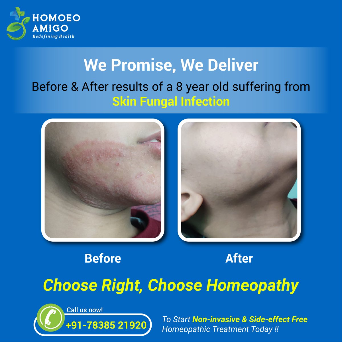 HomoeoAmigo's tweet photo. We Promise and We Deliver

Happy to share results of a 8 year old suffering from skin fungal infection, post treatment from Homoeo Amigo.

#skinfungalinfection #chooseright #choosehomeopathy #trendingnow #homeopathyworks #solutions #connected #followus #contactnow https://t.co/kxEX5I6sdo