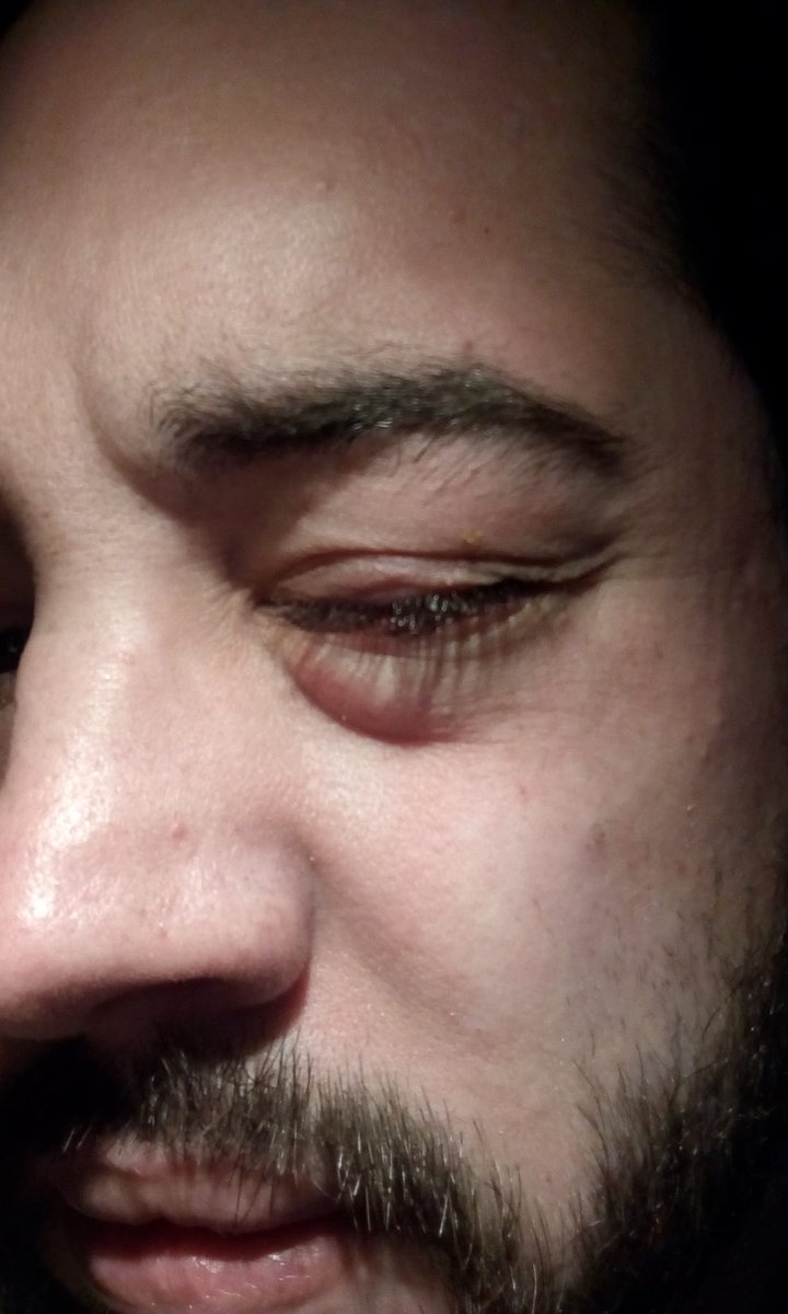 🤕Parche fuera🤕

Ya me retiraron hoy el parche, solo me queda bajar la hinchazón, descansar el ojo y que se me cierren las heridas.

Muchas gracias por preocuparos! Un besote enorme 😘