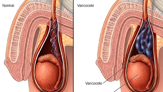 Relación entre varicocele, disfunción sexual y niveles séricos de testosterona. 👇 androgenital.com/noticias/relac…