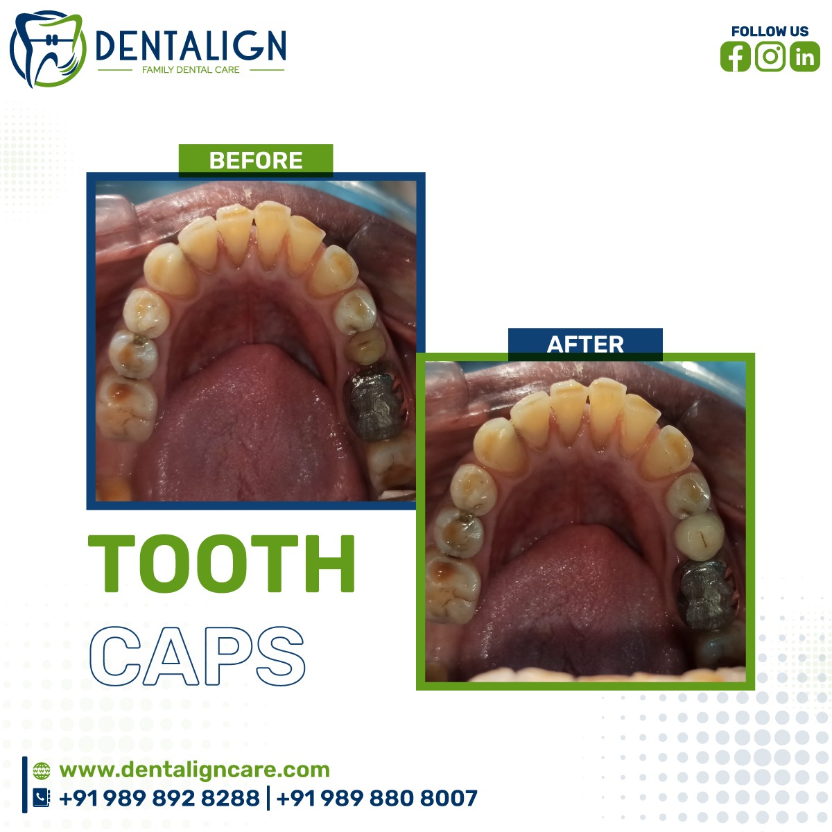 DentalignCare's tweet photo. Protect your smile with tooth caps: the ultimate solution for damaged or weakened teeth.
Looking for a reliable dental care solution? Dentalign has got you covered! Our tooth caps are designed to provide long-lasting protection to your teeth.

#dentalign #dentalcare #prothesis https://t.co/J1b0d6DrT9
