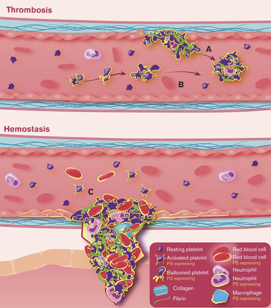 Alastair Poole (@alastair_poole) on Twitter photo Platelet procoagulant membrane dynamics: a key distinction between thrombosis and hemostasis? ashpublications.org/bloodadvances/… Happy to see this commentary now out in <a href="/BloodAdvances/">Blood Advances</a> Team work with <a href="/EjaifeAgbani/">Ejaife Agbani</a> <a href="/HersIngeborg/">Ingeborg Hers</a> Platelet procoagulant membrane dynamics: a key distinction between thrombosis and hemostasis? ashpublications.org/bloodadvances/… Happy to see this commentary now out in <a href="/BloodAdvances/">Blood Advances</a> Team work with <a href="/EjaifeAgbani/">Ejaife Agbani</a> <a href="/HersIngeborg/">Ingeborg Hers</a>