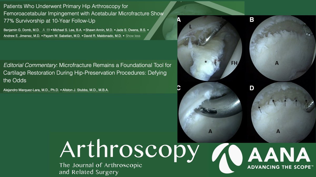 ArthroscopyJ's tweet photo. 77% Survivorship at 10 yrs for #Microfracture of the Acetabulum during #HipArthroscopy for #FAI...   
https://t.co/ll6G8BmJYm
With Commentary: 
https://t.co/hJmDB6rHUP https://t.co/TXOZeRHsWD