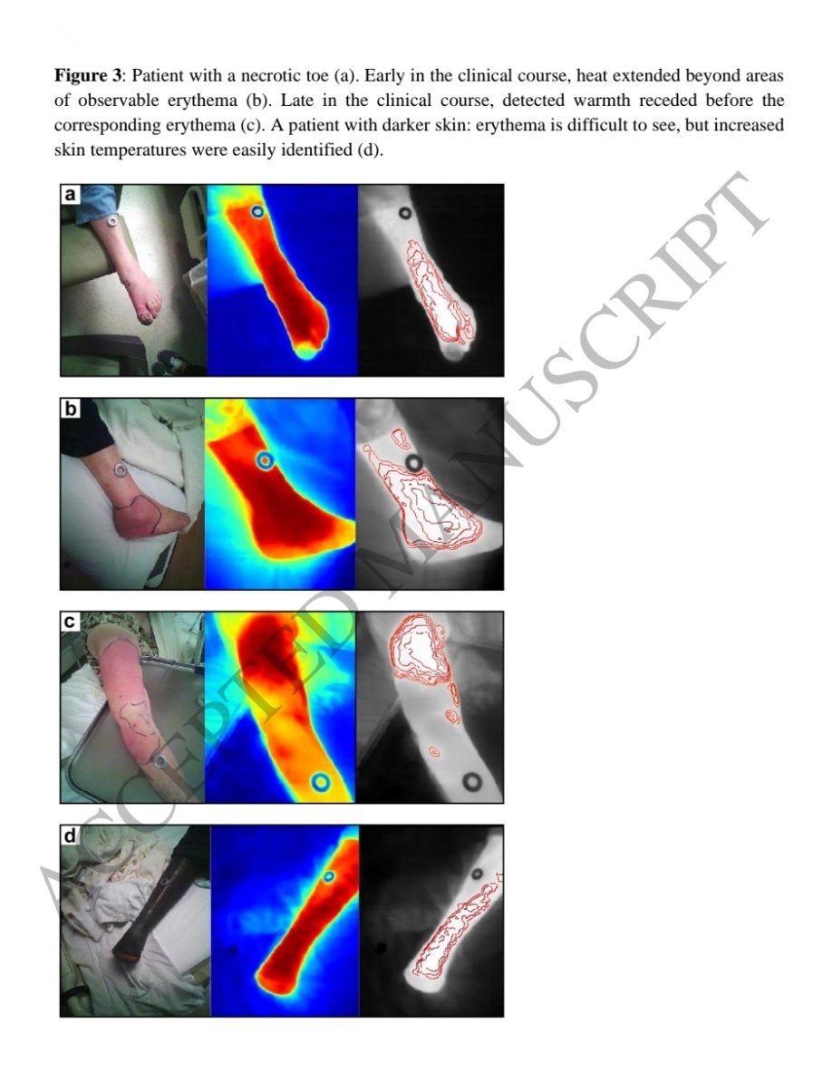 Antibiotic Steward Bassam Ghanem 🅱️C🆔🅿️🌟 (@absteward) on Twitter photo Super interesting ⚡️ ⚡️ <a href="/OFIDJournal/">Open Forum Infectious Diseases</a>
Using Thermal Imaging to Track Cellulitis #IDTwitter
Cc <a href="/DrToddLee/">Todd C. Lee</a> academic.oup.com/ofid/advance-a… Super interesting ⚡️ ⚡️ <a href="/OFIDJournal/">Open Forum Infectious Diseases</a>
Using Thermal Imaging to Track Cellulitis #IDTwitter
Cc <a href="/DrToddLee/">Todd C. Lee</a> academic.oup.com/ofid/advance-a…