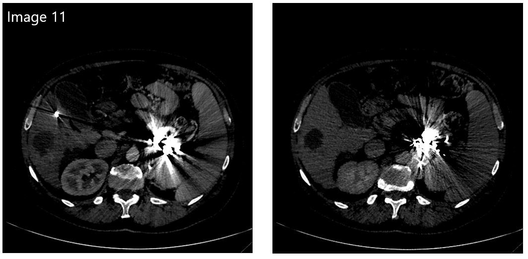cirsesociety's tweet photo. 4. The final CBCT control demonstrates correct chemoembolization of the nodule with good drug distribution. #TACE #varicesembolization #coils #glue #OLT #withoutscalpel (6/6) https://t.co/TMHrGeCa8M