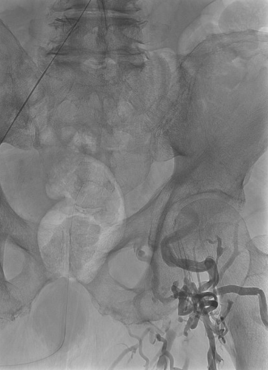 parkhurst42's tweet photo. Patient with #Optease filter placed at an #OSH 6 years ago presents with PTS including venous ulcers (Villalta 28) after 3 prior failed retrieval attempts.
After #filterout and reconstruction, patient now with significantly improved PTS (Villalta 10) and healed venous ulcers. https://t.co/NpM3Avi1VW