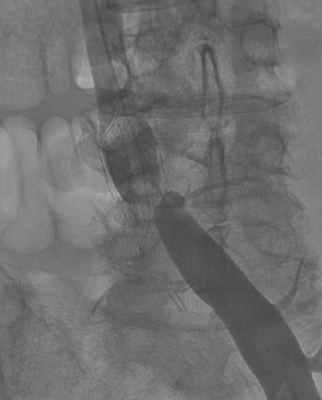 parkhurst42's tweet photo. Patient with #Optease filter placed at an #OSH 6 years ago presents with PTS including venous ulcers (Villalta 28) after 3 prior failed retrieval attempts.
After #filterout and reconstruction, patient now with significantly improved PTS (Villalta 10) and healed venous ulcers. https://t.co/NpM3Avi1VW