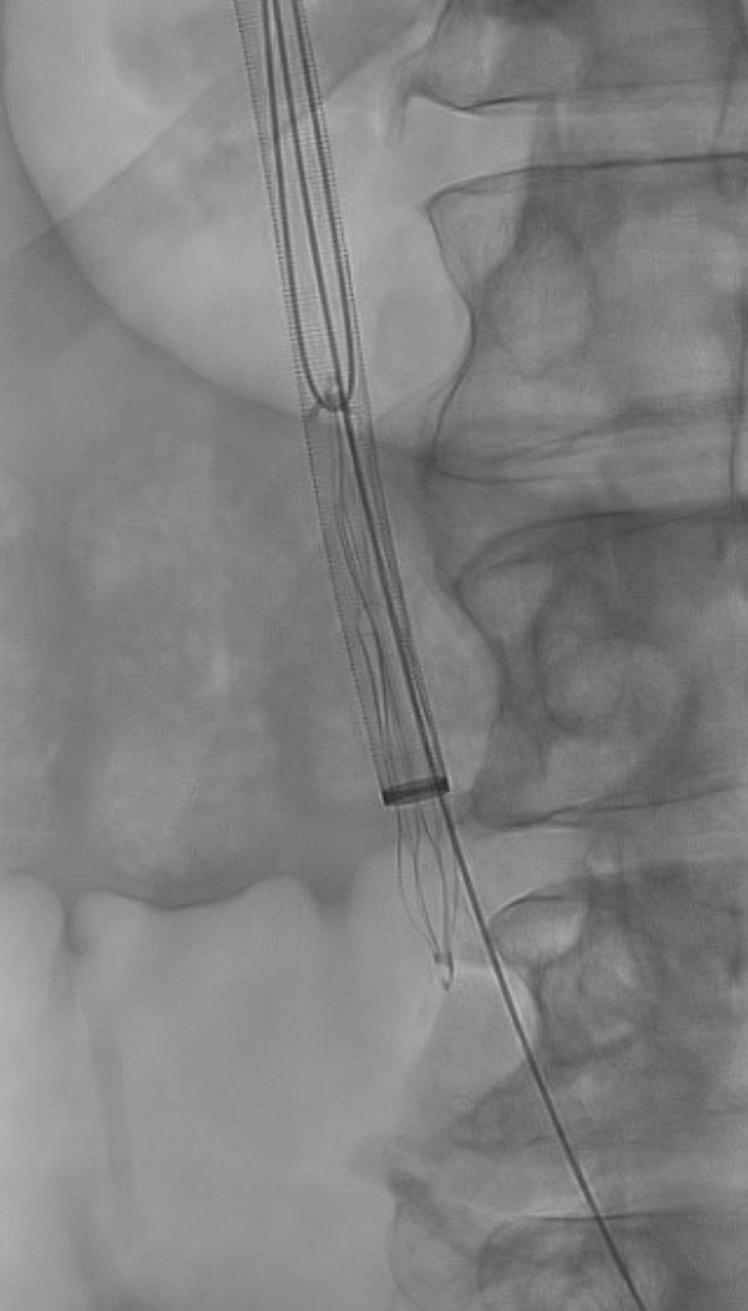 parkhurst42's tweet photo. Patient with #Optease filter placed at an #OSH 6 years ago presents with PTS including venous ulcers (Villalta 28) after 3 prior failed retrieval attempts.
After #filterout and reconstruction, patient now with significantly improved PTS (Villalta 10) and healed venous ulcers. https://t.co/NpM3Avi1VW