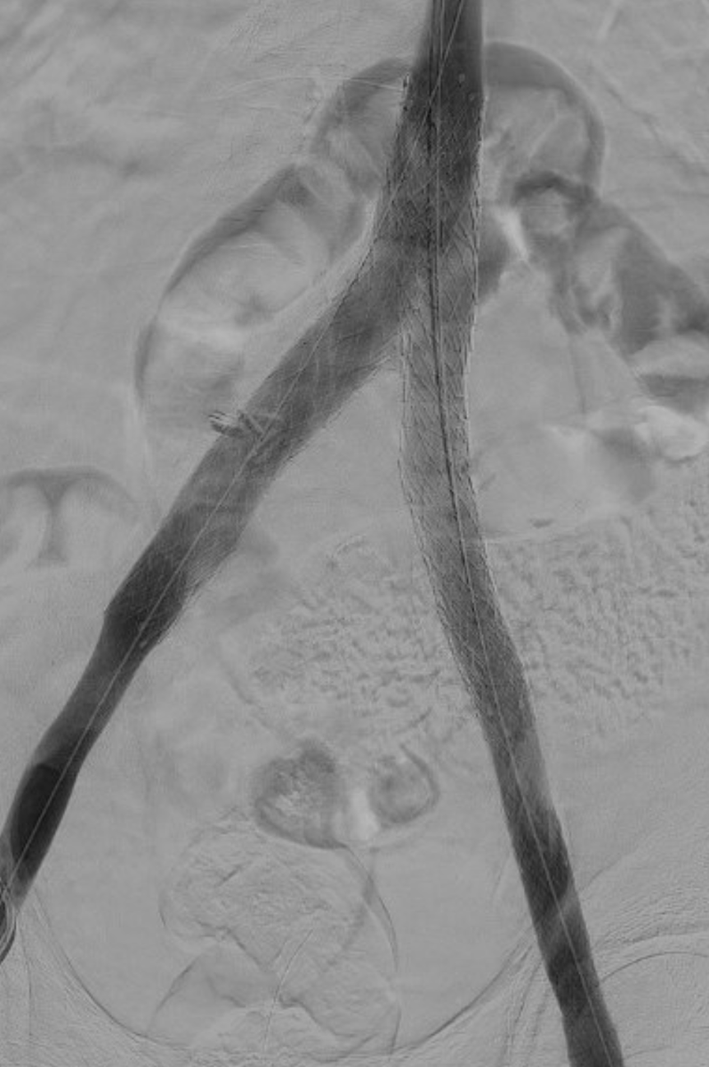 parkhurst42's tweet photo. Patient with #Optease filter placed at an #OSH 6 years ago presents with PTS including venous ulcers (Villalta 28) after 3 prior failed retrieval attempts.
After #filterout and reconstruction, patient now with significantly improved PTS (Villalta 10) and healed venous ulcers. https://t.co/NpM3Avi1VW