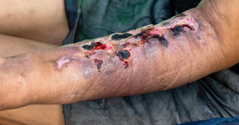NEJM's tweet photo. Use of xylazine, most often in combination with other drugs such as fentanyl, is a rapidly growing health threat. Xylazine use has been associated with severe necrotic skin ulcerations (photo). People being harmed by this drug deserve rapid, comprehensive, and high-quality care.