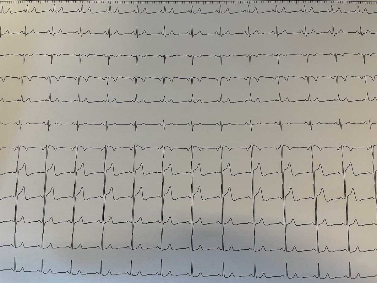 rfablation's tweet photo. #EPeeps ventricular bigeminy mapped by #omnipolartechnology #HDGrid at the left coronary cusp. Rapidly effective #radiofrequency just below at site of 12/12 pacemapping. No need for #Fluoro @messapus https://t.co/UeTBOHJuPf