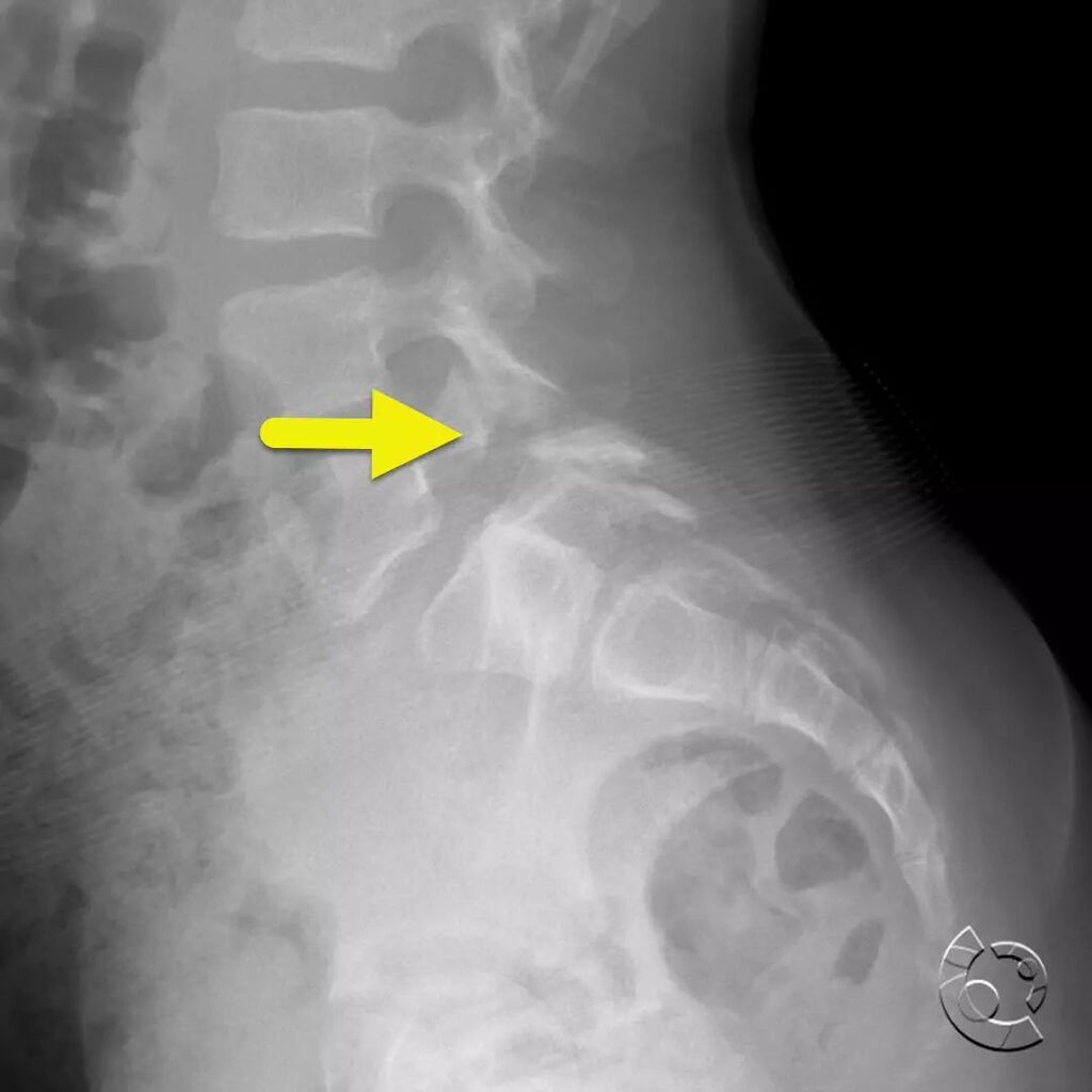 CincyKidsRad's tweet photo. Lateral radiograph of the lumbar spine shows a pars defect (arrow) at the L5 level with mild anteriolisthesis of L5 on S1. Pars defects most commonly occur at the L5 level. They are relatively common occurring in approximately 1 and 20 patients. Most pat… https://t.co/ijjFS2T786 https://t.co/ZjR4xNoqYb