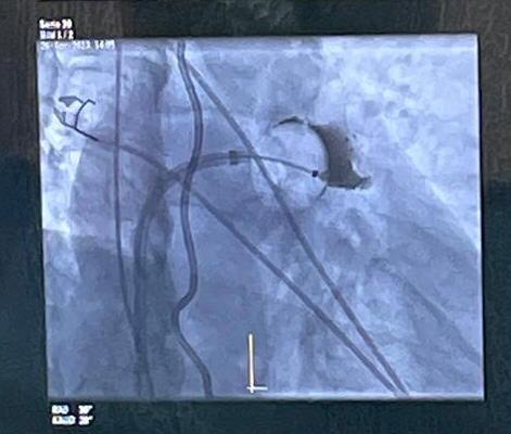 RolandTilz's tweet image. ❄️ICE AGE 2 - First in EUROPE
➡️Next Generation variable #CryoBalloon 
👉#POLARFit fits common ostium and #LAA 
💪#LALALAND AF
🙏team #EPLuebeck @ChristianHeeger @giuliavogler 
@FeherMarcel @EPyoungstar 
#EPeeps #innovation #UKSH @YoungDgk @AGEP_DGK @VivekReddyMD @DrJasonAndrade