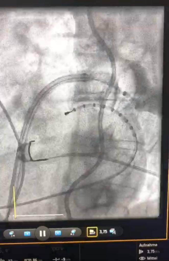 RolandTilz's tweet image. ❄️ICE AGE 2 - First in EUROPE
➡️Next Generation variable #CryoBalloon 
👉#POLARFit fits common ostium and #LAA 
💪#LALALAND AF
🙏team #EPLuebeck @ChristianHeeger @giuliavogler 
@FeherMarcel @EPyoungstar 
#EPeeps #innovation #UKSH @YoungDgk @AGEP_DGK @VivekReddyMD @DrJasonAndrade