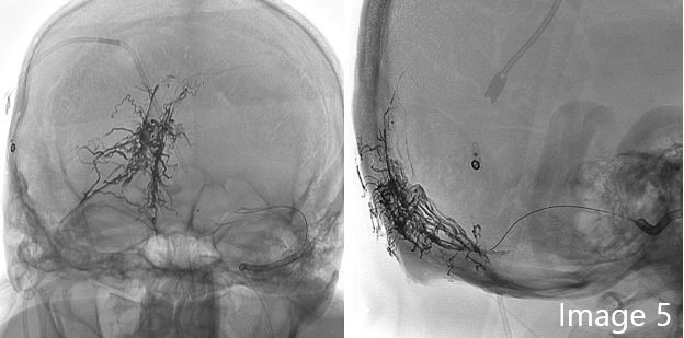 cirsesociety's tweet photo. Image 5 shows the final check during endovascular treatment, and image 6 shows MR follow-up at six months. 

Case by Dr. C. Cirelli, @docbiro, @ChiaraGaudino, @LMilonia, @SalcuniAndrea, A. Di Ruzza @adiruzzamd, @fmaricchetti (5/5) https://t.co/9gPLupPlPL