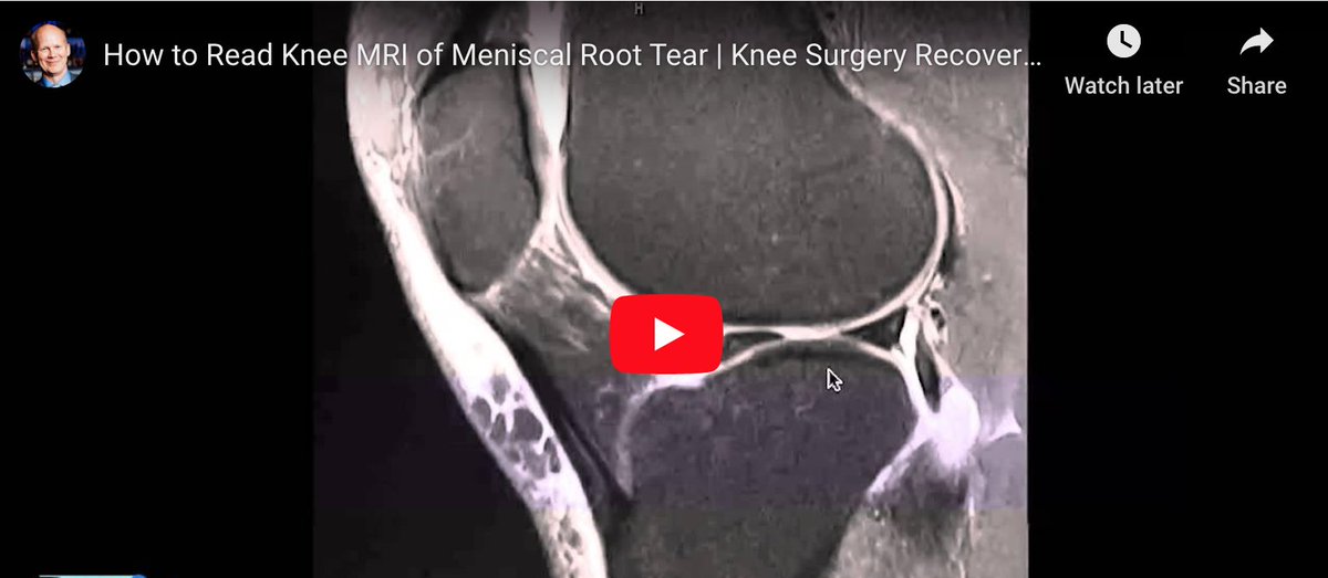 thekneedoc's tweet photo. In this video, Dr. LaPrade discusses how to read an #MRI of a meniscal root tear. #Meniscus root tears have only been identified within the last 5-6 years, but new research has indicated the importance of identifying &amp; repairing these types of injuries. https://t.co/3kIi0PckqW https://t.co/Qaf31fwTL5