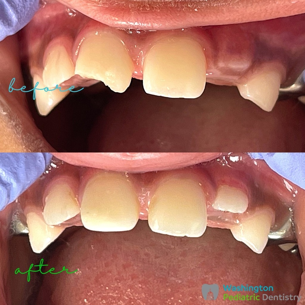 WashingtonPDent's tweet photo. This patient had a collision with her brother while playing and fractured her permanent front tooth. We fixed it and restored her smile 😊 💪🏾🦷✨

#downtownsilverspring #silverspringpediatricdentist #dckidsdentist #dmvpediatricdentist #dcpediatricdentist #teamWPD #silverspring … https://t.co/0JtxyLcebi
