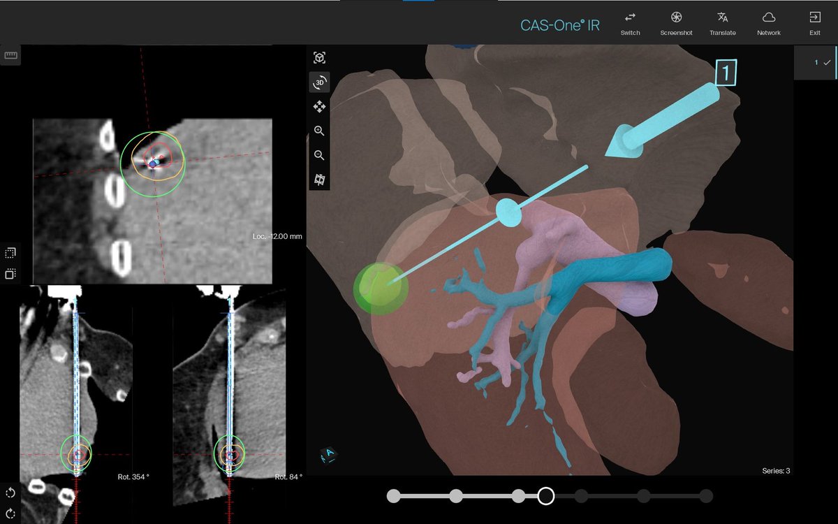 CAScination's tweet photo. We are happy to share this month's CAS-One IR top case.
The patient is a 69-year-old female presented with a metastatic SCLC lesion in Segment VII of the Liver. Cryoablation was the chosen method of treatment for this lesion.
Read the full top case :
https://t.co/TQsr8iSfXq https://t.co/bzikz0Cho1