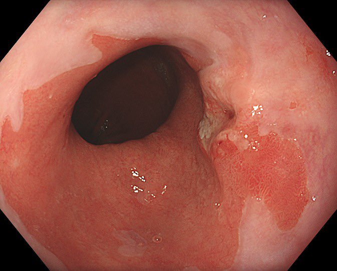 drkeithsiau's tweet photo. View of the oesophagus in a patient with chronic reflux. What’s the diagnosis? https://t.co/DQFR18UoQA
