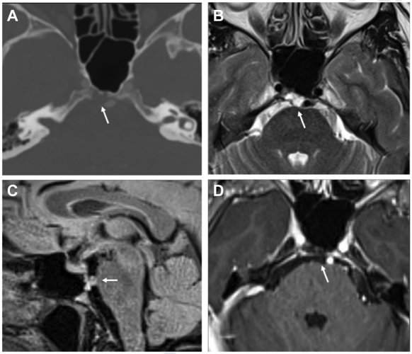 Mayo Clinic ENT (@mayoclinicent) on Twitter photo Is the follow-up data in the current literature adequate to distinguish ecchordosis physaliphora from chordomas?
Click to learn more: bit.ly/3HiqKY1
#ENT #MayoENTresearch #skullbase #chordoma <a href="/JamieVanGompel/">Jamie Van Gompel MD</a> #GarretChoby Is the follow-up data in the current literature adequate to distinguish ecchordosis physaliphora from chordomas?
Click to learn more: bit.ly/3HiqKY1
#ENT #MayoENTresearch #skullbase #chordoma <a href="/JamieVanGompel/">Jamie Van Gompel MD</a> #GarretChoby