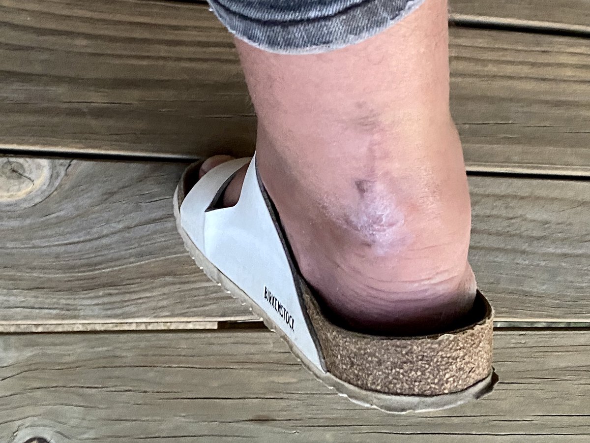 dannicholl's tweet photo. First anniversary of snapping my Achilles chasing an accidental @Kookie_Kuhle drop shot (and the lady from #PadelSA telling the paramedic she thought the patient was about 60). Long road, made immeasurably easier by the brilliant @SpeechlyEvan. Return to golf is finally in sight! https://t.co/Pxhu3BReZw