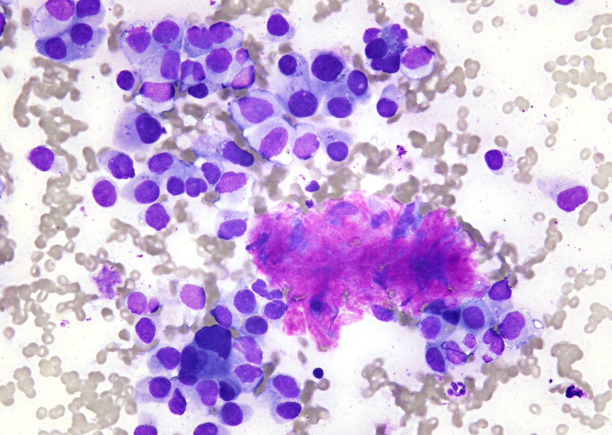 Another one for the trainees - Medullary Thyroid Carcinoma (plasmacytoid, loosely dispersed cells and amyloid) (FNA)