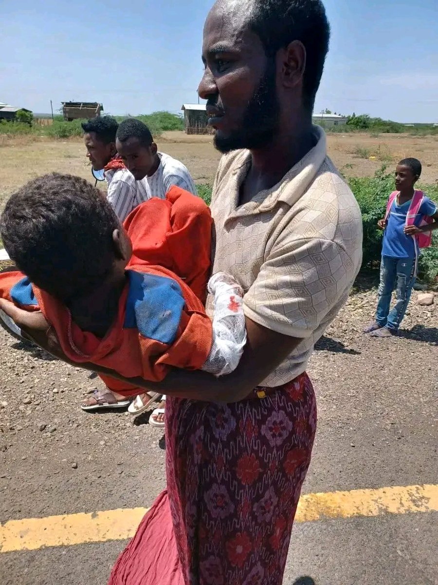 Dankaliann's tweet photo. Afar children are still dying by z bombs that were installed by the tplf during their war on Afar pastoralists.
#attention4kasagita 
#Afar 
@AbiyAhmedAli 
@RedwanHussien 
@walta_info 
@WHOEthiopia 
@awolarba 
@EPHIEthiopia 
@mfaethiopia 
@DemekeHasen 
@FMoHealth https://t.co/5k1re3aN47