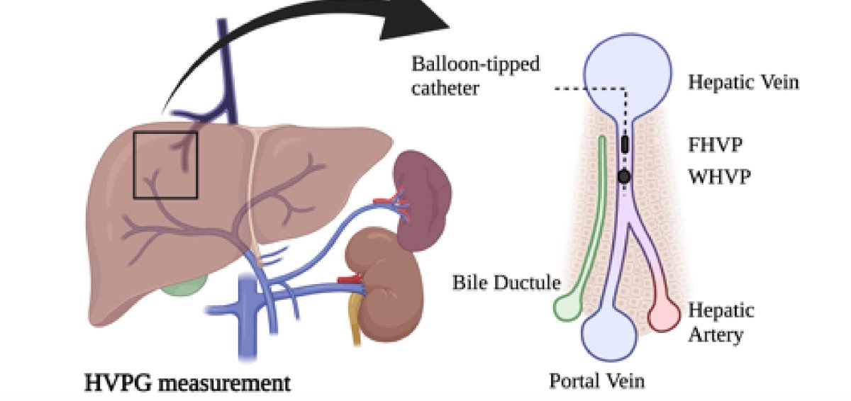 Infographic of how it's performed for trainees who are unaware of HVPG #fgdebate