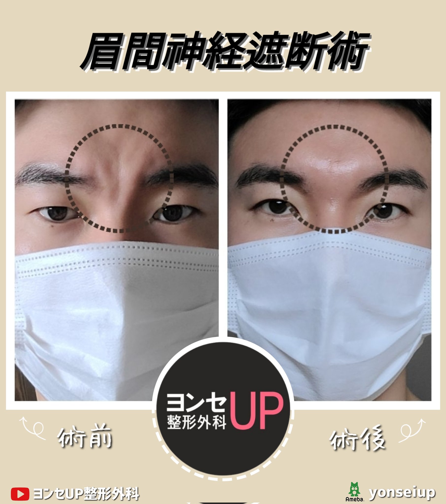 みけんに皺　 30代の眉間のシワでお悩みの方：眉間の動きを弱める皺眉筋切除