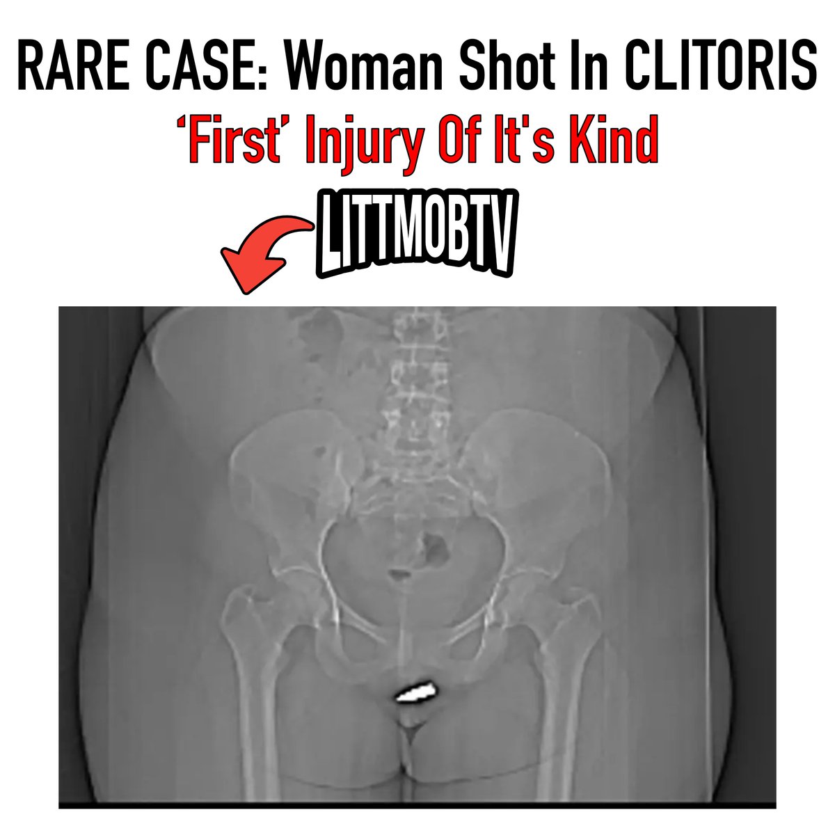 littmobtv's tweet photo. Somali woman undergoes emergency surgery after a stray bullet pierces her clitoris in a rare and shocking case, as reported in the International Journal of Surgery Case Reports. #Somalia #littmobtv https://t.co/6N8i3dNYmA
