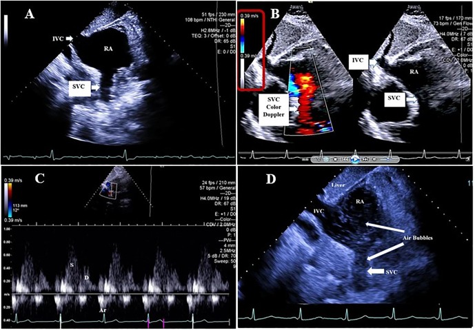 pocus_today's tweet photo. Transthoracic Evaluation of the SVC is difficult  - Description of 3 classical TTE windows here 👇
🔗https://t.co/pBJCY81LSN
#FOAMcc #FOAMed #MedTwitter #POCUS https://t.co/px3vFDzv7s