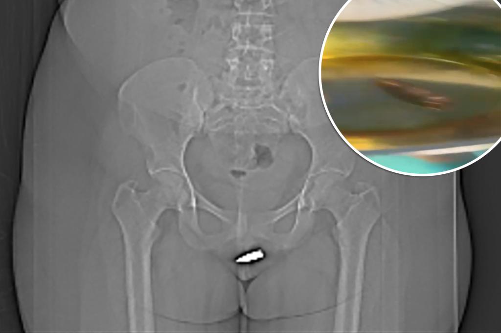 World-First Surgery Successfully Removes Bullet from CLITORIS World-First Surgery Successfully Removes Bullet from CLITORIS